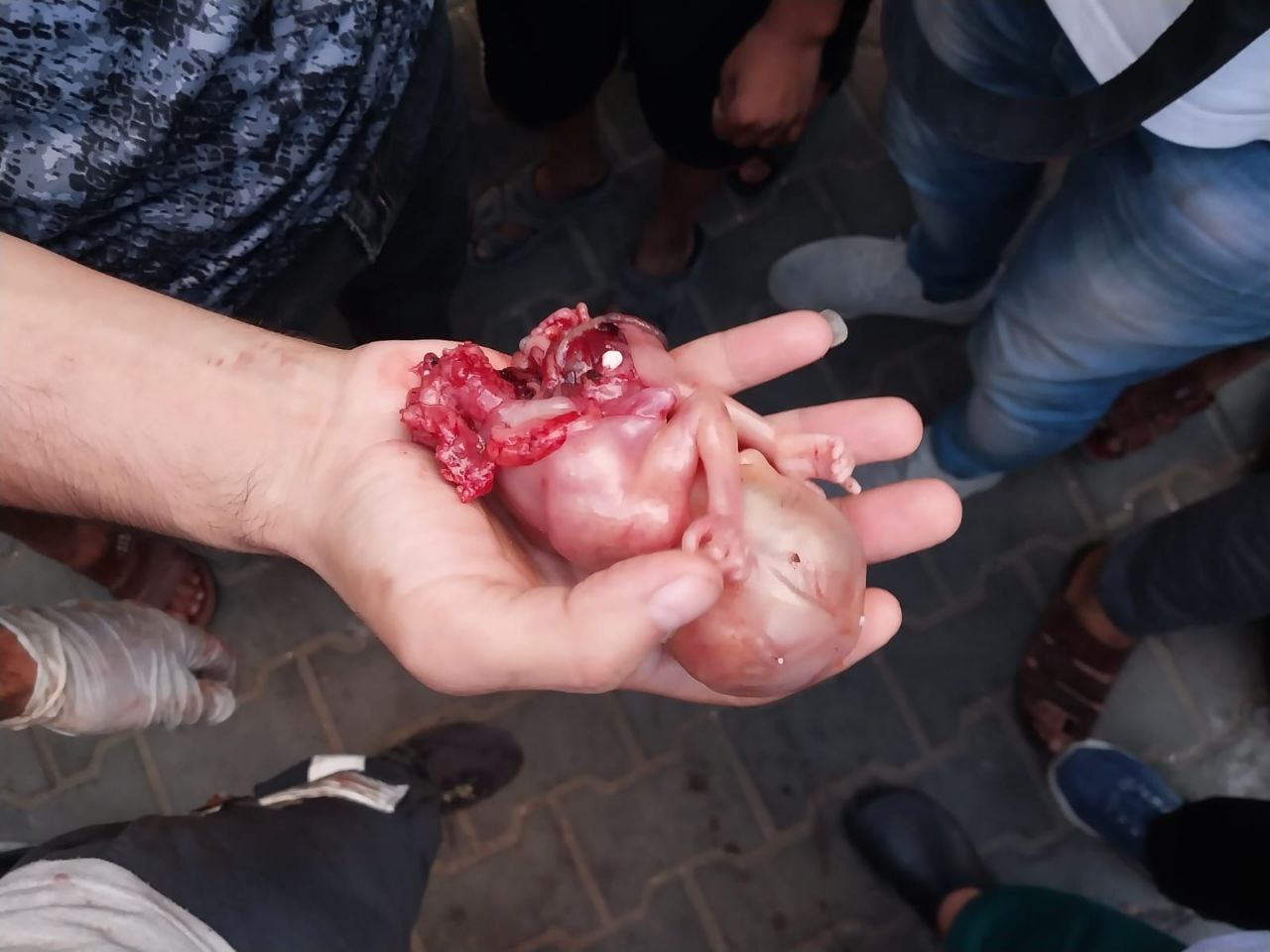 תמונה מזעזעת של עובר שנחתך מבטן אימו שחוסלה עי פלסטינים 7-10-2023